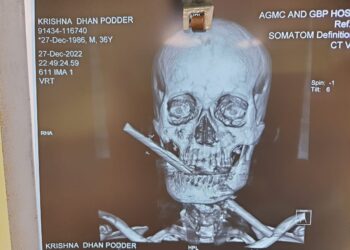 Doctors set an example again after complex surgery