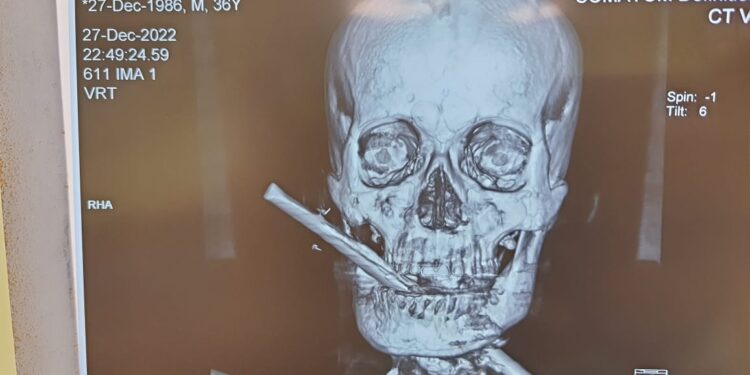 Doctors set an example again after complex surgery