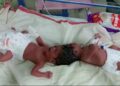 Woman gives birth to conjoined child