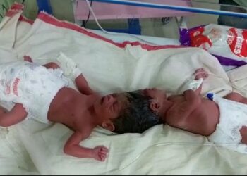 Woman gives birth to conjoined child