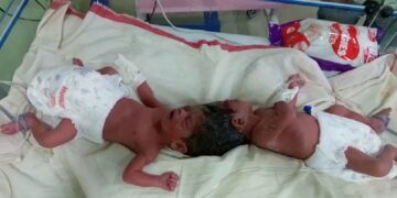 Woman gives birth to conjoined child