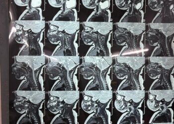 43-Day-Old Newborn Undergoes Rare Branchial Cyst Surgery in Amarpur, Marking a First in India