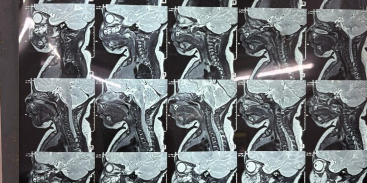 43-Day-Old Newborn Undergoes Rare Branchial Cyst Surgery in Amarpur, Marking a First in India